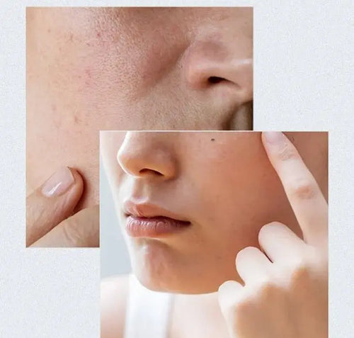 Anua - Birch Moisture Boosting Serum - 30ml